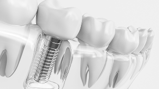 栃木県真岡市でインプラント治療なら｜勝田デンタルクリニック