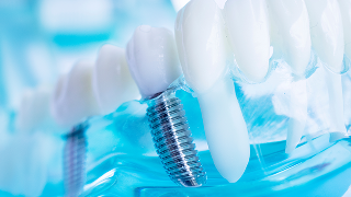 栃木県真岡市でインプラント治療なら｜勝田デンタルクリニック