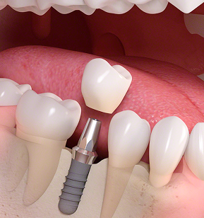 栃木県真岡市でインプラント治療なら｜勝田デンタルクリニックのインプラント治療