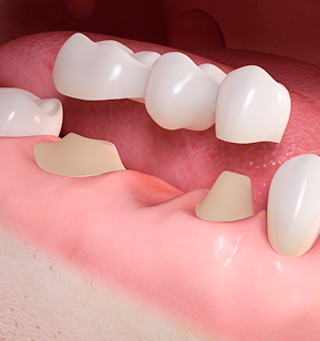 栃木県真岡市でインプラント治療なら｜勝田デンタルクリニックのインプラント治療