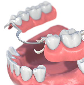 栃木県真岡市でインプラント治療なら｜勝田デンタルクリニックのインプラント治療