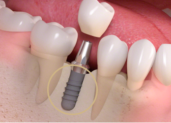栃木県真岡市でインプラント治療なら｜勝田デンタルクリニックインプラントの構造