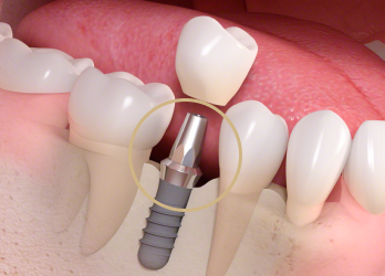 栃木県真岡市でインプラント治療なら｜勝田デンタルクリニックインプラントの構造