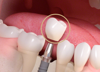 栃木県真岡市でインプラント治療なら｜勝田デンタルクリニックインプラントの構造