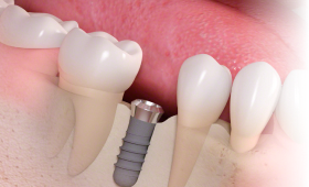 栃木県真岡市でインプラント治療なら｜勝田デンタルクリニックインプラント治療の流れ