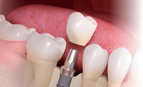 栃木県真岡市でインプラント治療なら｜勝田デンタルクリニックインプラント治療の流れ