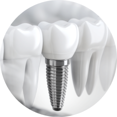 インプラント治療のイメージ画像