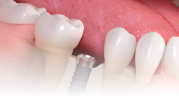 栃木県真岡市でインプラント治療なら｜勝田デンタルクリニックインプラント治療の流れ