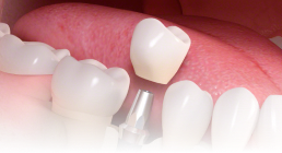 栃木県真岡市でインプラント治療なら｜勝田デンタルクリニックインプラント治療の流れ